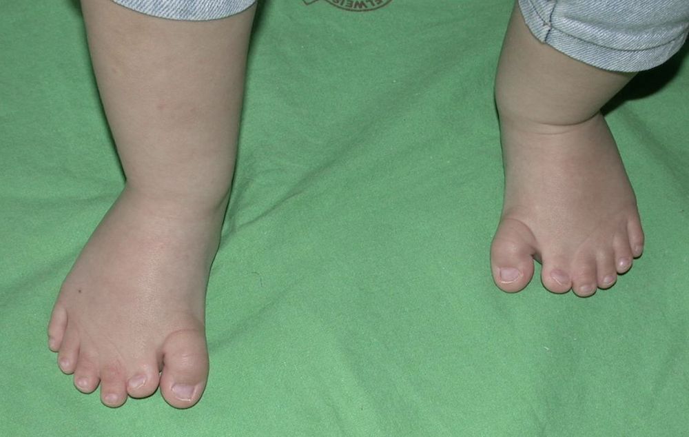 Polydactylia